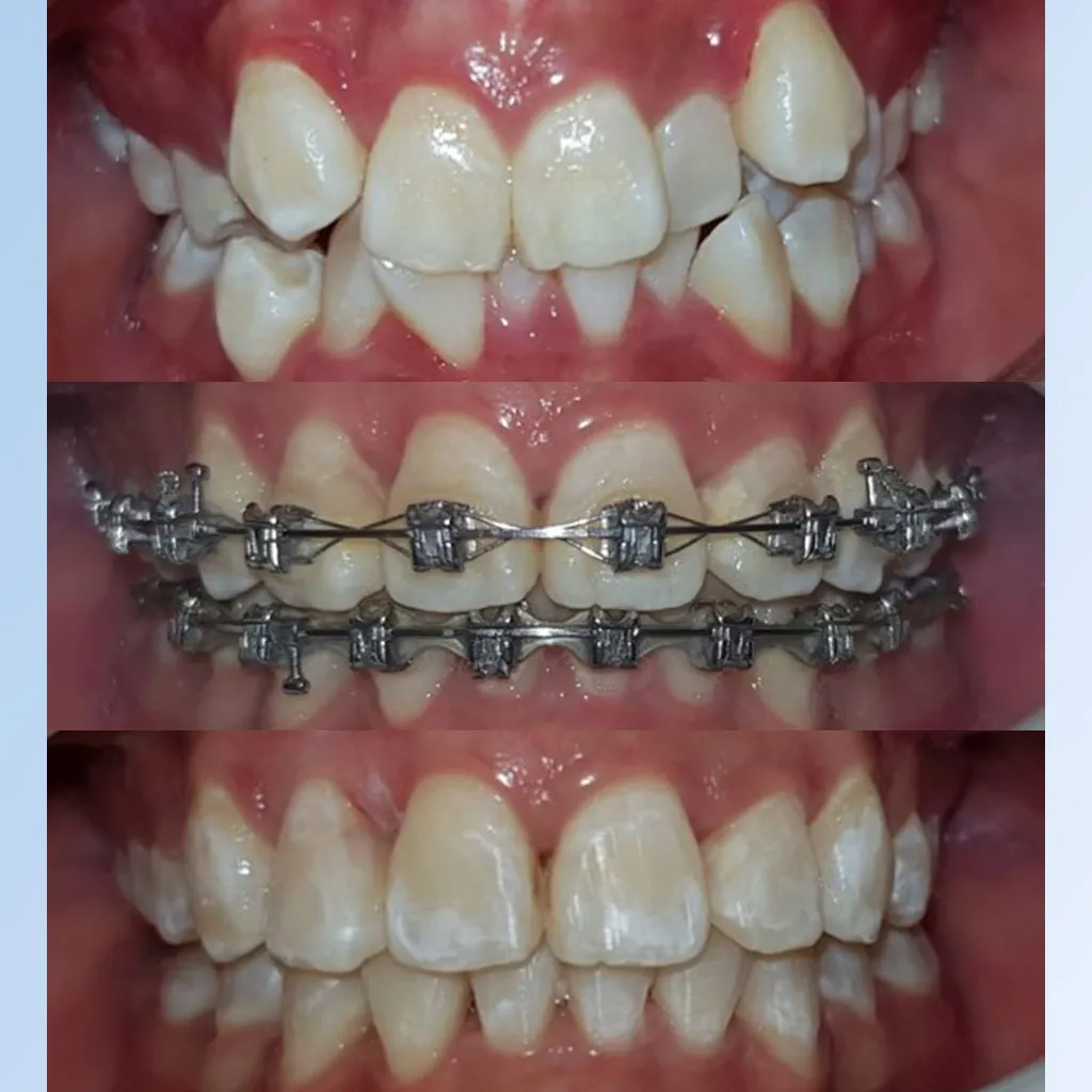 Dental Braces Package